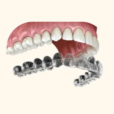 Aligners